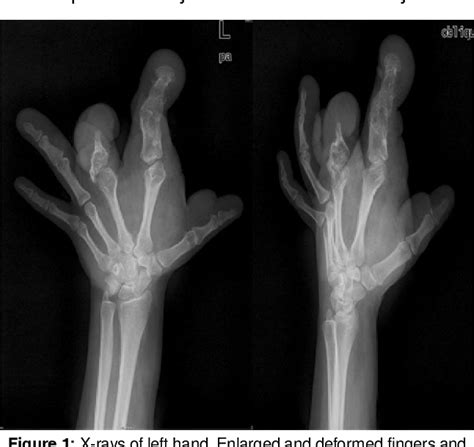 Figure 1 From Carpal Tunnel Syndrome In Fibrolipomatous Hamartoma Of