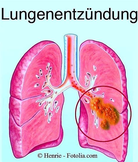 Symptome der Lungenentzündung Anzeichen Husten ansteckend Fieber