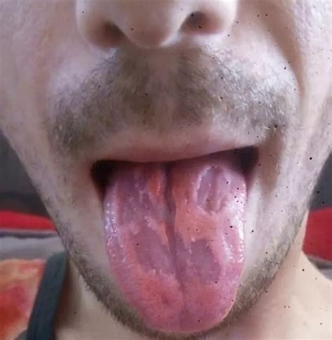 Man S Tongue Eaten Away After He Downed SIX Energy Drinks Every Day