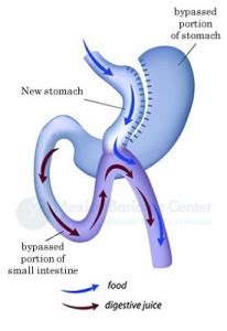 Mini Gastric Bypass Surgery in Mexico: Tijuana Surgeons from $6,195