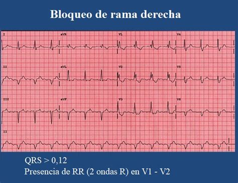 Bloqueo De Rama Derecha O Izquierda Causas S Ntomas Y Complicaciones