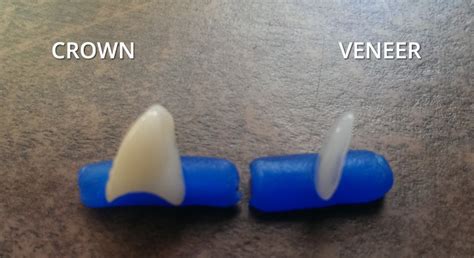 Veneers vs Crowns: Cost and Durability - Headgear Braces