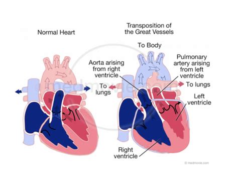 Congenital Heart Disease Flashcards Quizlet