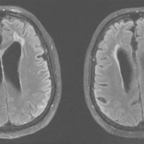 The Axial FLAIR MRI Showed Moderate Dilatation Of Both Lateral