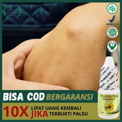 Obat Benjolan Di Tangan Tradisional Benjolan Di Tangan Kanan Kiri