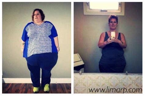 Antes Y Despues Bypass Gastrico Bitmoms