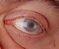 Category Maroteauxlamy Syndrome Wikimedia Commons