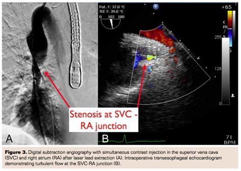 Endovascular Stenting Of The Superior Vena Cava Right Atrial Junction