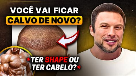 Implante Capilar E Anabolizante O Cabelo Vai Cair De Novo Muzy