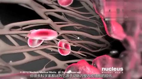 3d医学动画 动脉粥样硬化斑块形成腾讯视频