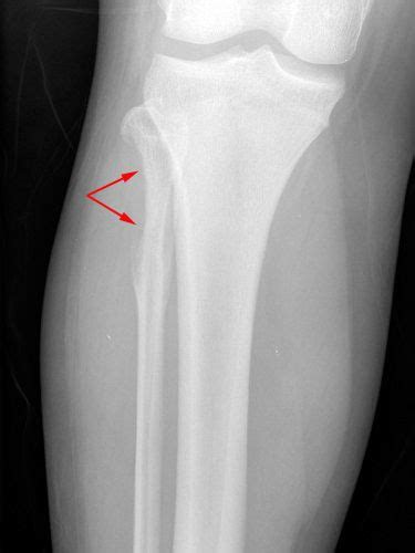 Ewing's Sarcoma - OrthoInfo - AAOS