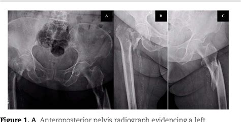 Figure 1 From Simultaneous Bilateral Extracapsular Proximal Femur Fractures In The Elderly A