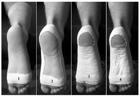 Plantar Fasciitis Taping