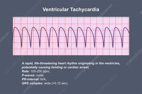 Ventricular Tachycardia Heartbeat Rhythm Illustration Stock Image F0417753 Science Photo