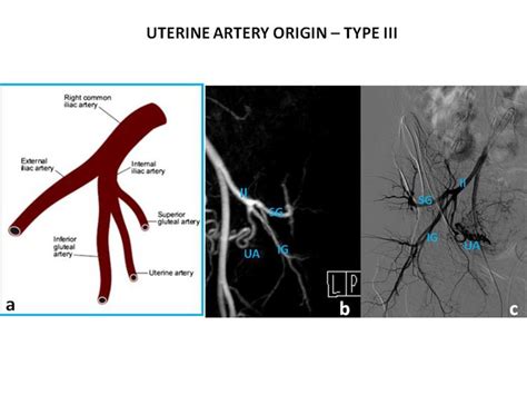 Mr Angiography In A 41 Year Old Woman Presenting For Preembolization