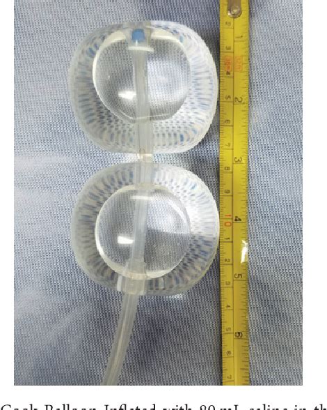 Figure From Double Balloon Cervical Ripening Catheter For Control Of