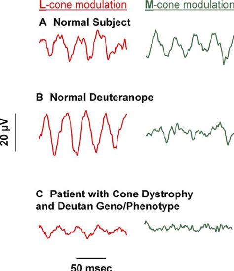 Averaged Electroretinographic Responses To Pure L Cone Modulation