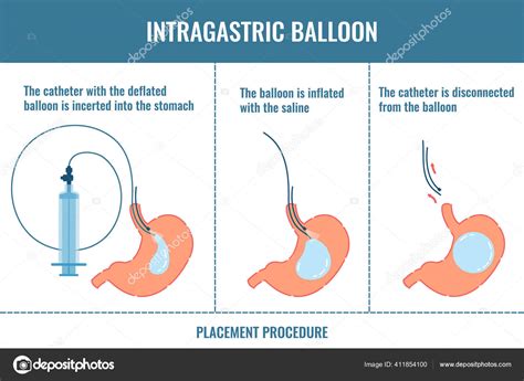 Gastric Balloon Weight Loss Procedure Phases Shown In Stomach Stock