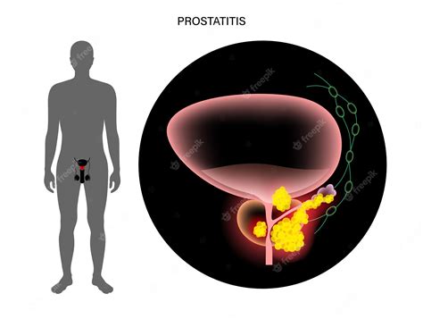 Premium Vector Prostate Cancer Concept