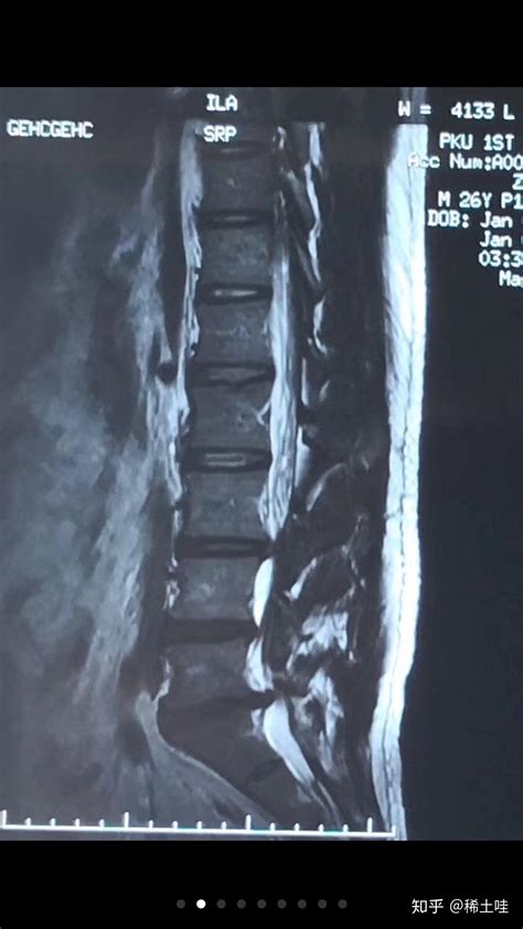腰椎间盘突出，我的治疗经过。 知乎