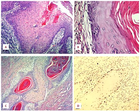 Hematoxylin And Eosin H E Stain Pseudoepitheliomatous