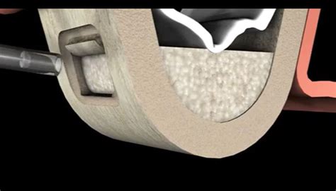 Bone And Sinus Grafting Austin Implants And Periodontics