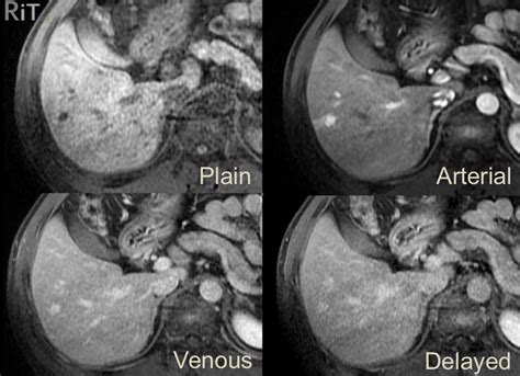 RiT radiology: Atypical Hepatic Hemangioma - Rapid Filling of Contrast