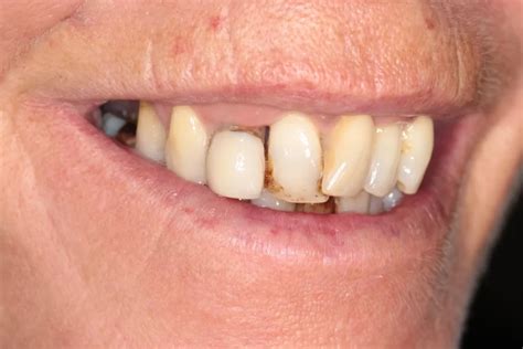 How Long Do Dental Implants Last VP Implantology