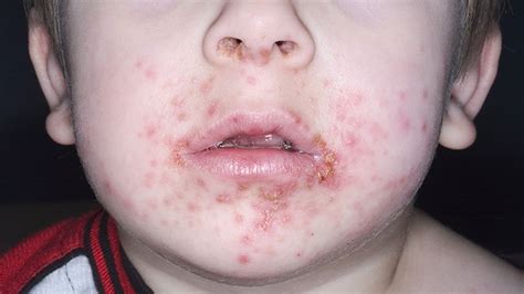 10 Impetigo FAQs and the Answers | Everyday Health