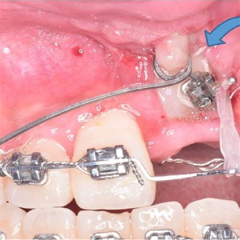 stage surgical exposure  apically positioned flap apf