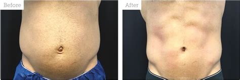 EMS Treatment (Electrical muscle stimulation) – Sculpted Beauty