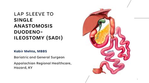 Lap Sleeve To Sadi Single Anastomosis Duodeno Ileostomy Kabir Mehta