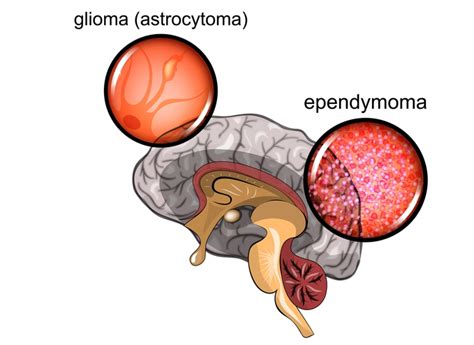 Astrocytoma