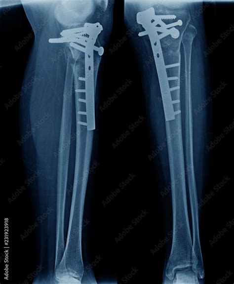 x-ray image of leg show tibia bone fixation Stock Photo | Adobe Stock