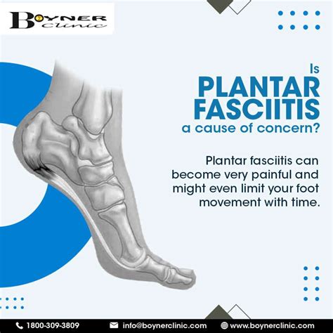 Treat Plantar Fasciitis With Custom Orthotics Boyner Clinic