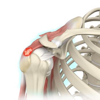 Calcific Tendinitis Of The Shoulder Reactive Calcification Seacoast