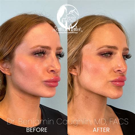 Combination Of Buccal Fat Removal Jawline Sculpting Chin Implant