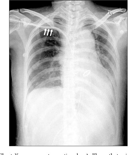 Figure From Massive Hemothorax Immediately After Removal Of Central