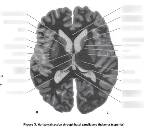 Basal Ganglia Figure 3 Horizontal Section Superior Diagram Quizlet