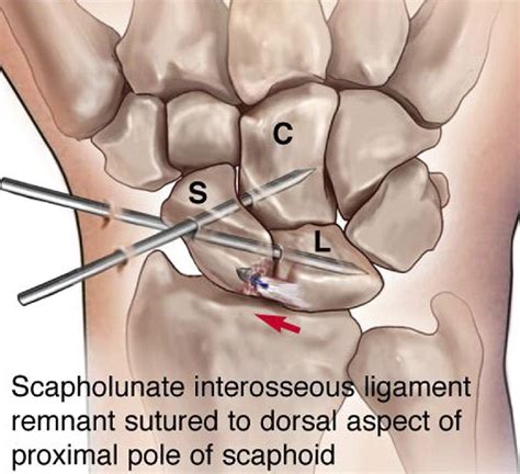 Scapholunate Ligament Repair With Capsulodesis Reinforcement Journal