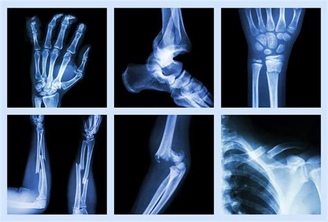 Broken Bones & Fractures | Symptoms & Treatment | Boulton Law Group