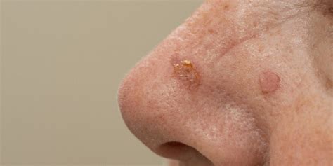 Actinic Keratosis Treatments Mesa AZ Sagebrush Dermatology