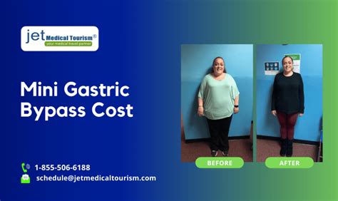 Mini Gastric Bypass Cost Jet Medical Tourism®