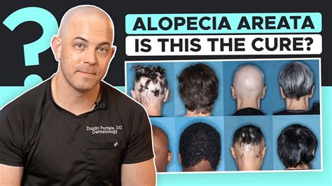 New Drug Olumiant Baracitinib Approved For Alopecia Areata YouTube