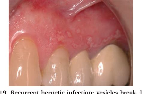 Acute Periodontal Lesions Semantic Scholar