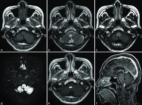 Preoperative Axial T1 Weighted A T2 Weighted B Fluid Attenuated Download Scientific