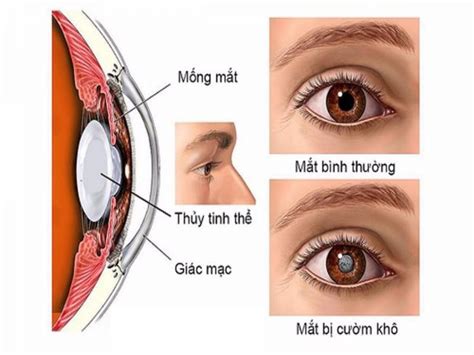 Bệnh cườm mắt là gì Cách phân biệt cườm khô và cườm nước Bệnh Viện