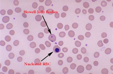 Inclusion Bodies of Red Blood Cells | Red blood cells, Abnormal cells ...
