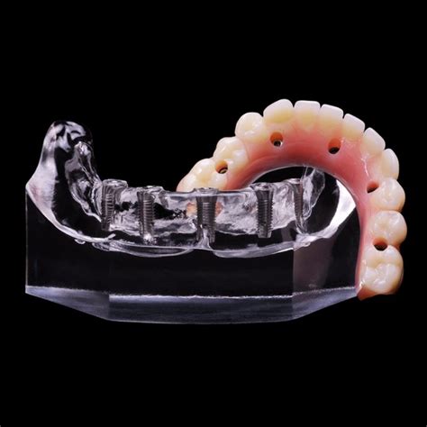 IM-10 Locator Overdenture (2 Zest Abutments over Implants) | Paradigm ...