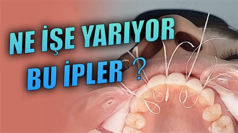 Retainer Diş Teli Pekiştirme Tedavisi YouTube